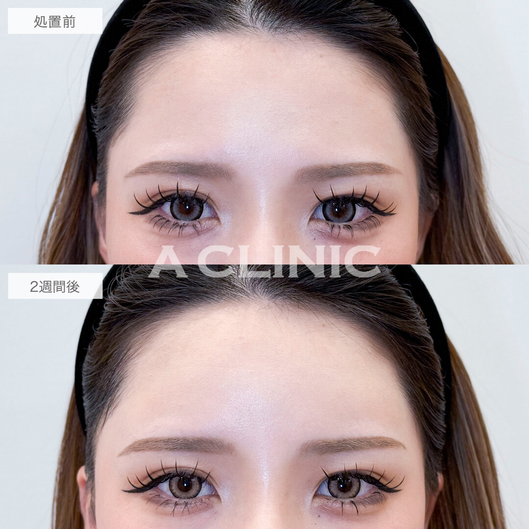 ヒアルロン酸カスタマイズメニューでつるんと丸い額を手に入れました！処置前と2週間後の症例です(20代女性)