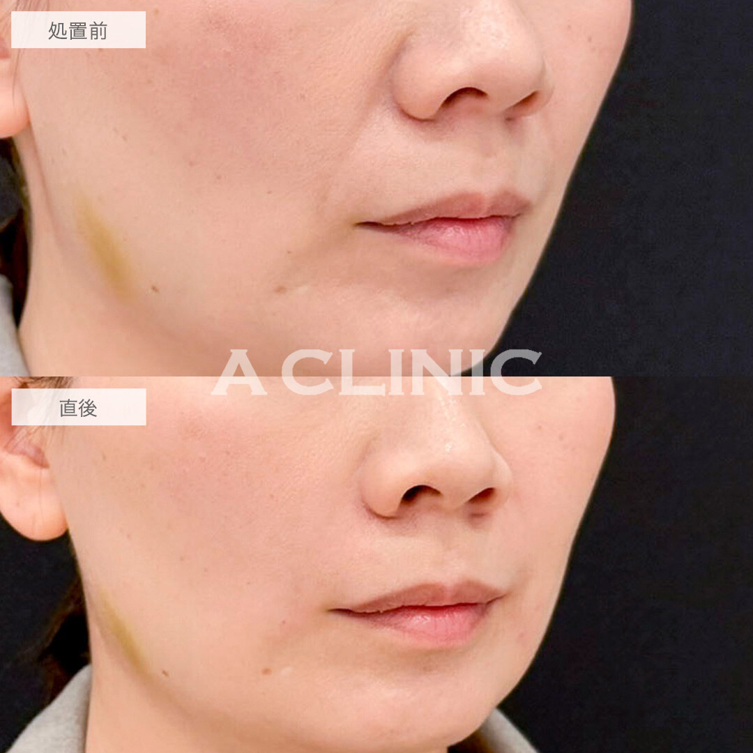 ヒアルロン酸注射(シワ)でほうれい線が目立たなくなりました！処置前と直後の症例です(40代女性)