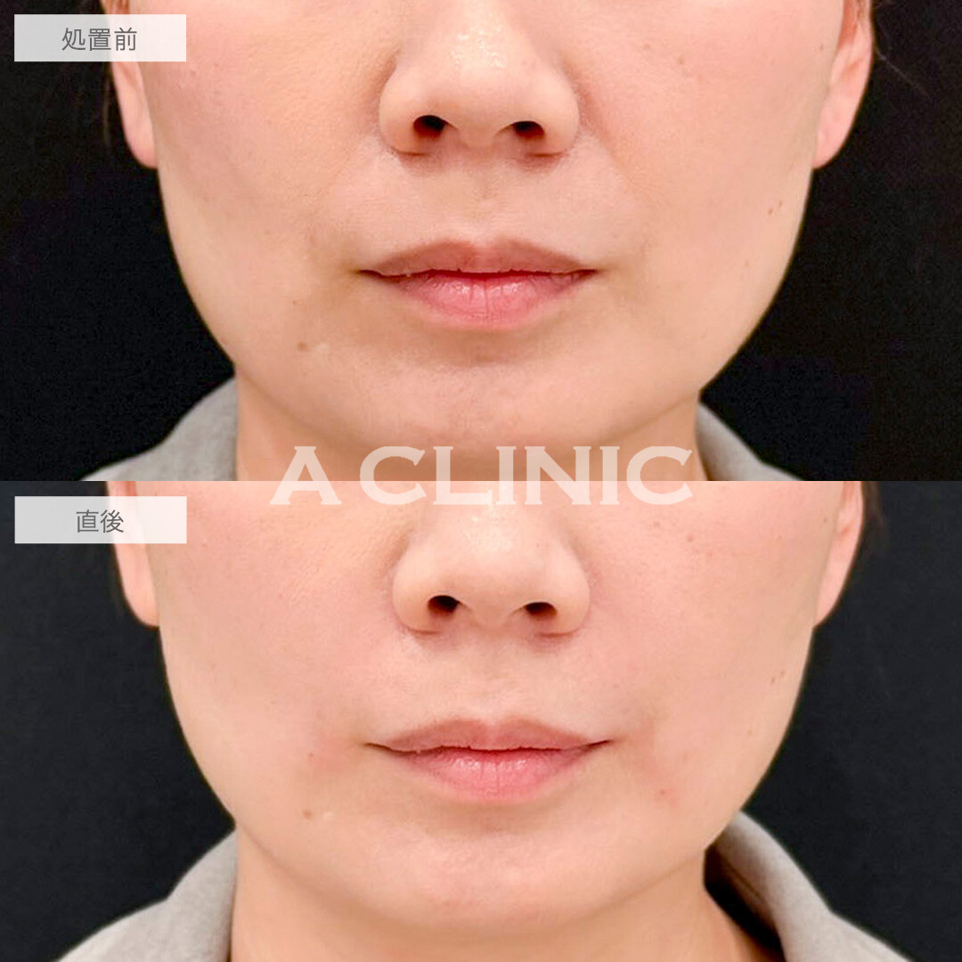 ヒアルロン酸注射(シワ)でほうれい線が目立たなくなりました！処置前と直後の症例です(40代女性)