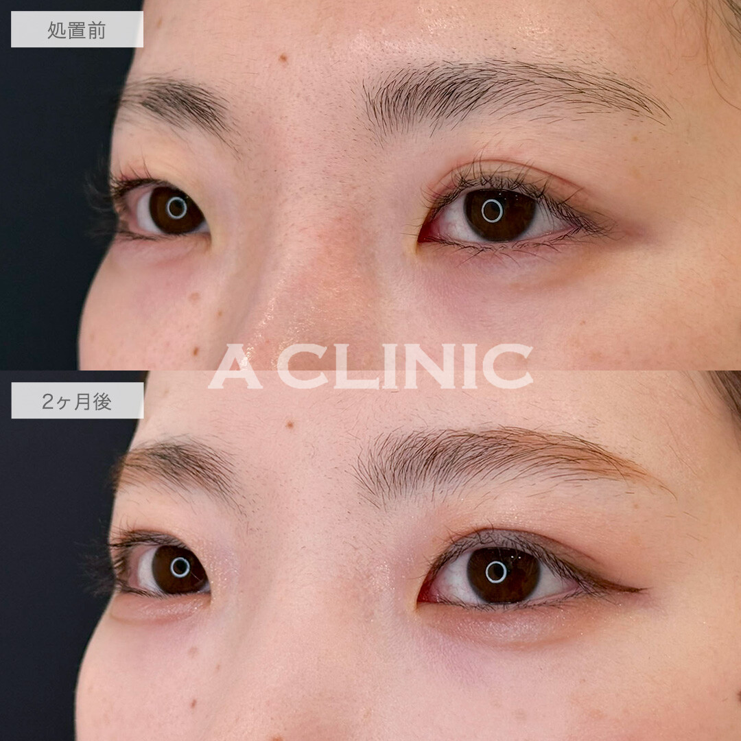 二重術埋没法で一番似合う場所でラインを作り可愛さアップ!こちら処置前と2ヶ月後の症例です(20代女性)