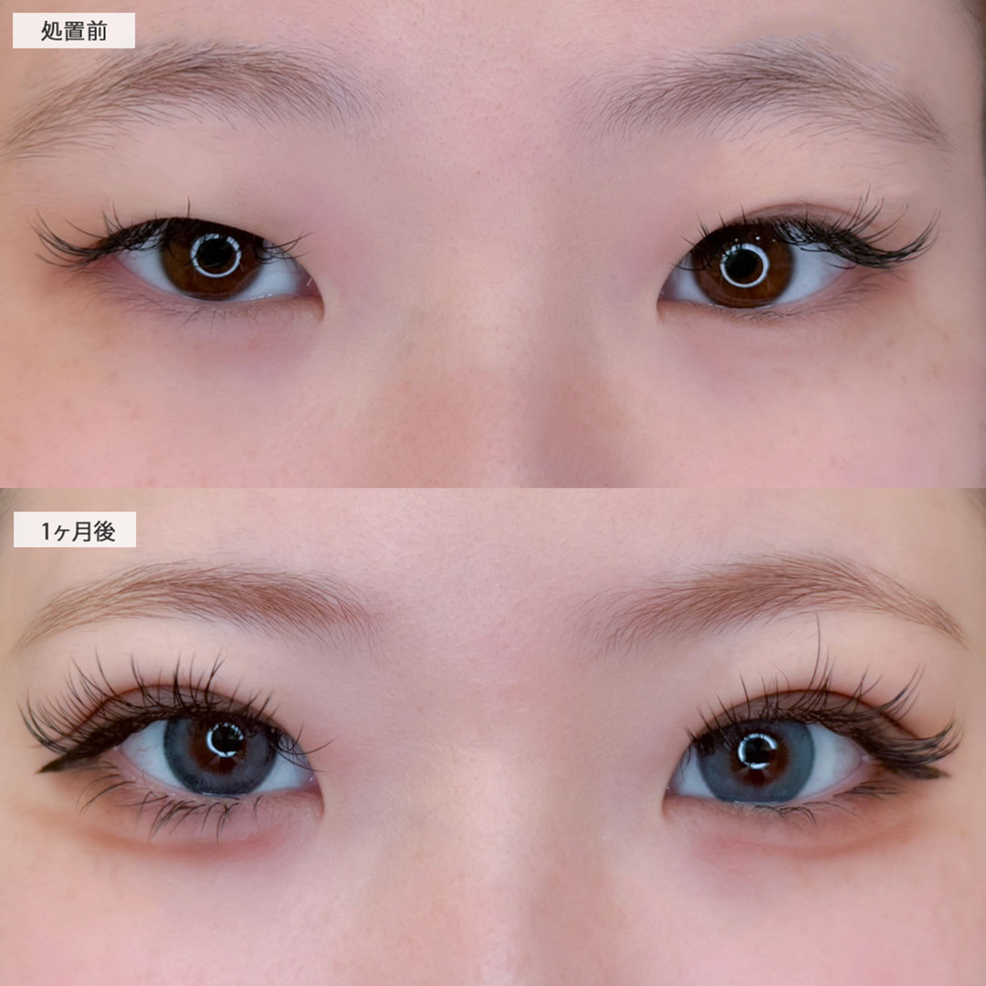 二重術埋没法で末広型のぱっちり二重が叶いました！こちら処置前と1ヶ月後の症例です(10代女性)