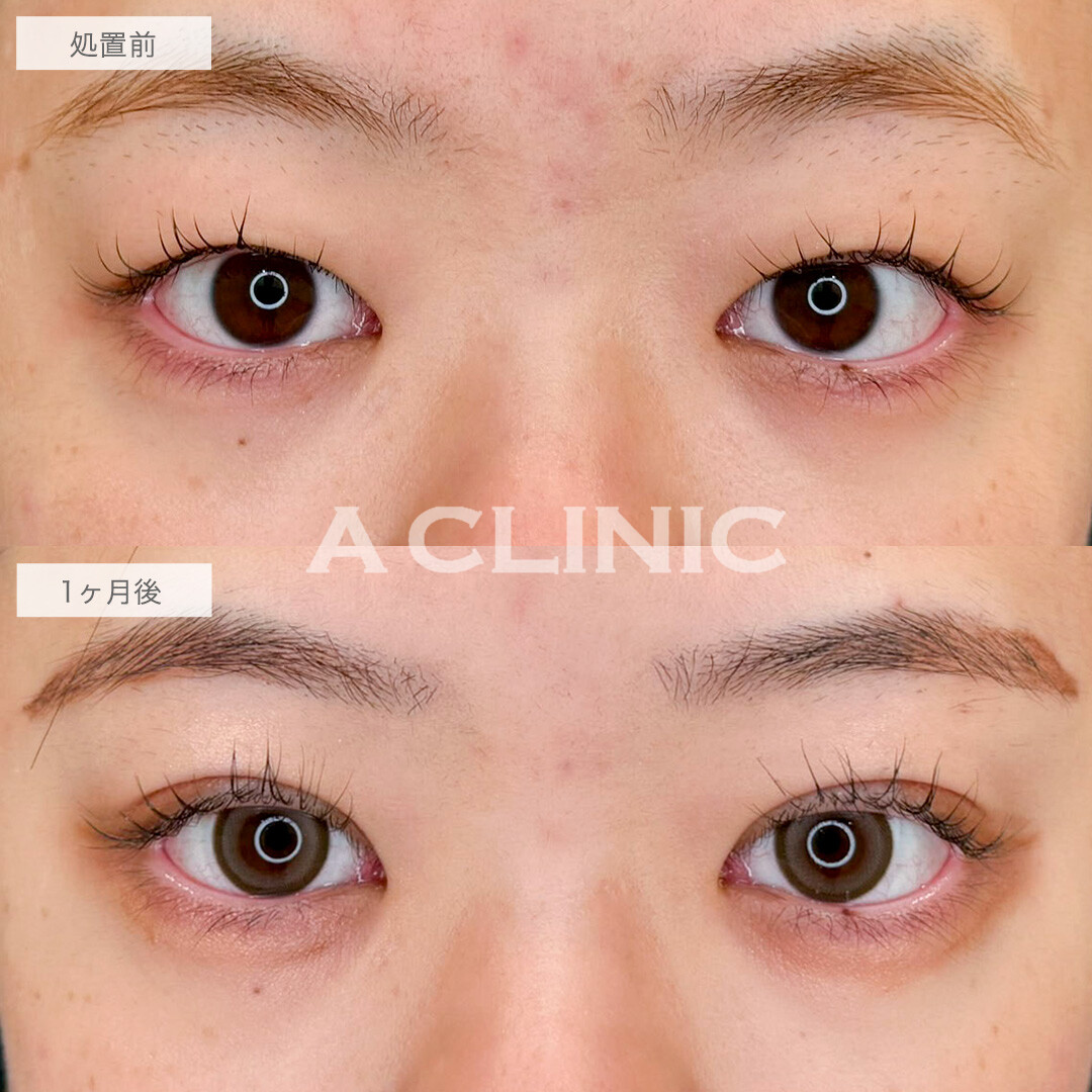 二重術埋没法と目の上の脂肪取りで重たい目がスッキリ美しい二重に!こちら処置前と1ヶ月後の症例です(20代女性)