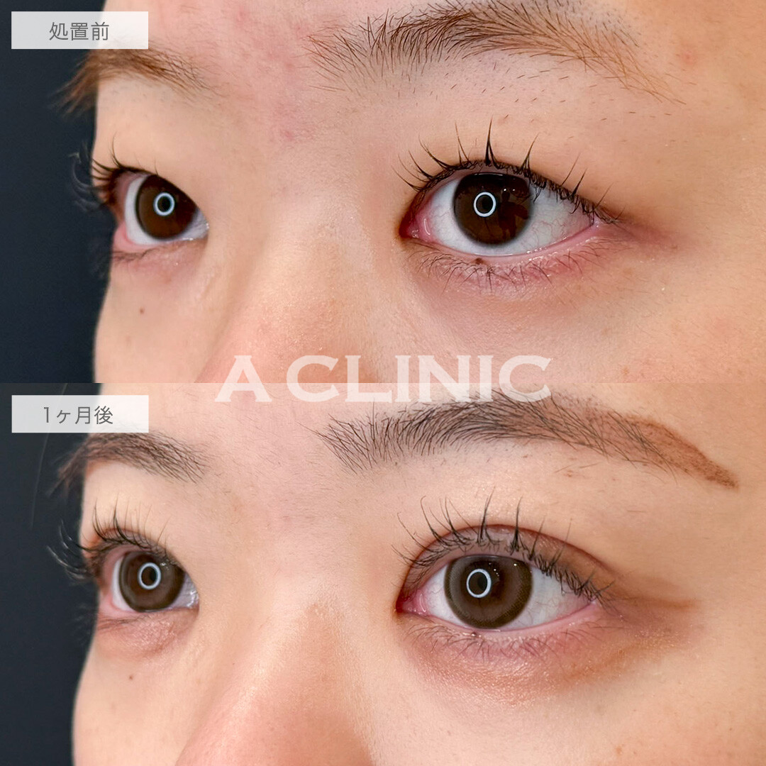 二重術埋没法と目の上の脂肪取りで重たい目がスッキリ美しい二重に!こちら処置前と1ヶ月後の症例です(20代女性)