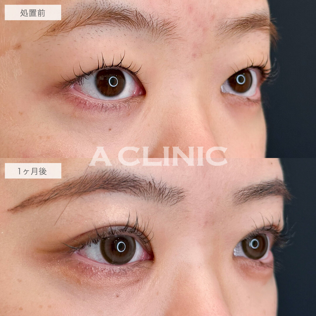 二重術埋没法と目の上の脂肪取りで重たい目がスッキリ美しい二重に!こちら処置前と1ヶ月後の症例です(20代女性)