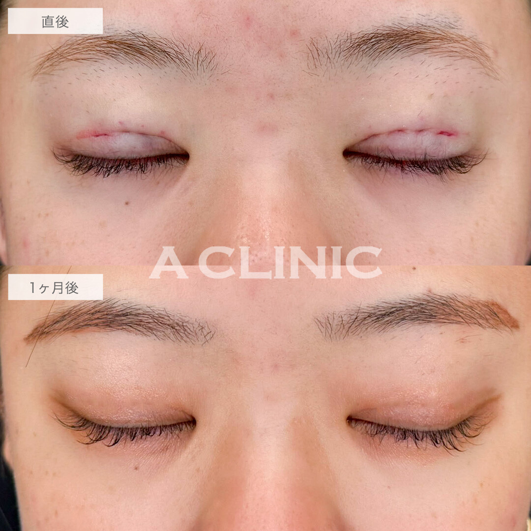 二重術埋没法と目の上の脂肪取りで重たい目がスッキリ美しい二重に!こちら処置前と1ヶ月後の症例です(20代女性)