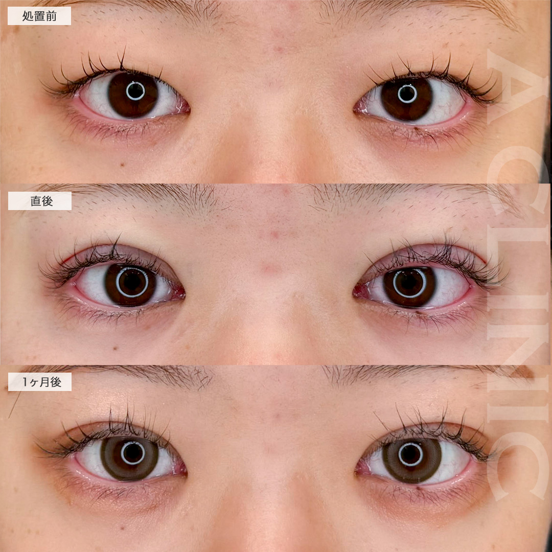 二重術埋没法と目の上の脂肪取りで重たい目がスッキリ美しい二重に!こちら処置前と1ヶ月後の症例です(20代女性)