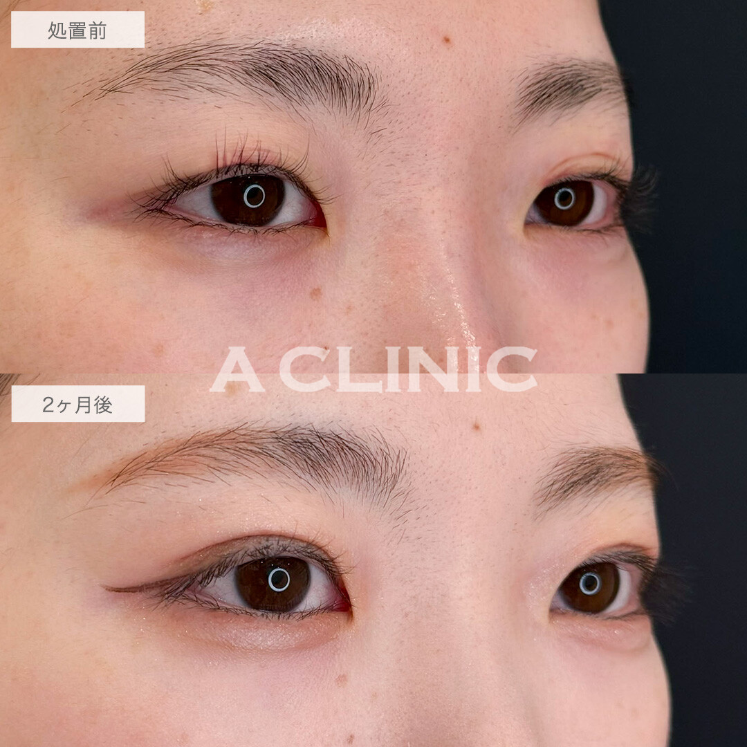 二重術埋没法で一番似合う場所でラインを作り可愛さアップ!こちら処置前と2ヶ月後の症例です(20代女性)