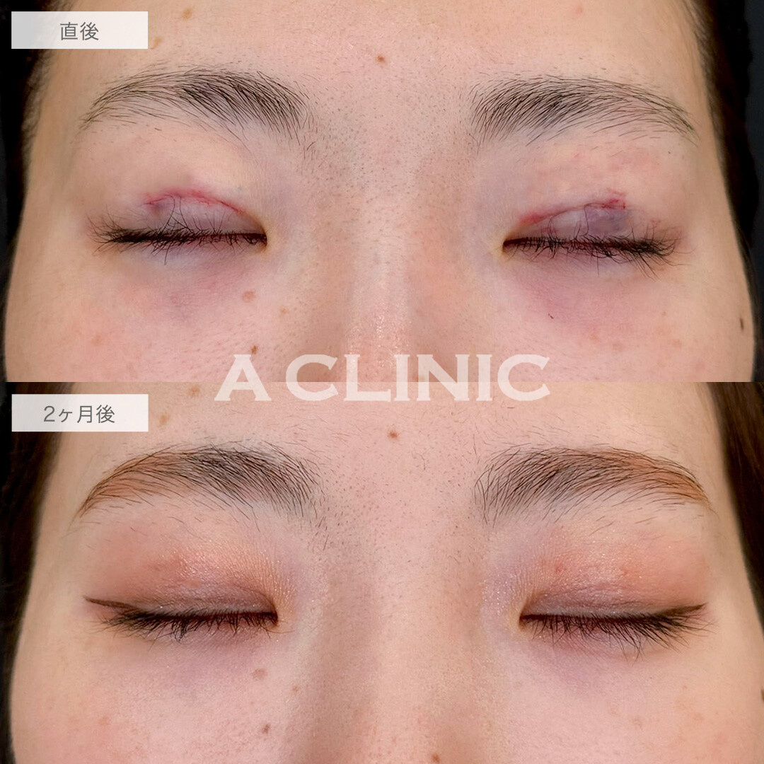 二重術埋没法で一番似合う場所でラインを作り可愛さアップ!こちら処置前と2ヶ月後の症例です(20代女性)