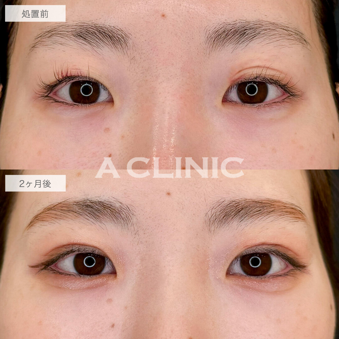 二重術埋没法で一番似合う場所でラインを作り可愛さアップ!こちら処置前と2ヶ月後の症例です(20代女性)