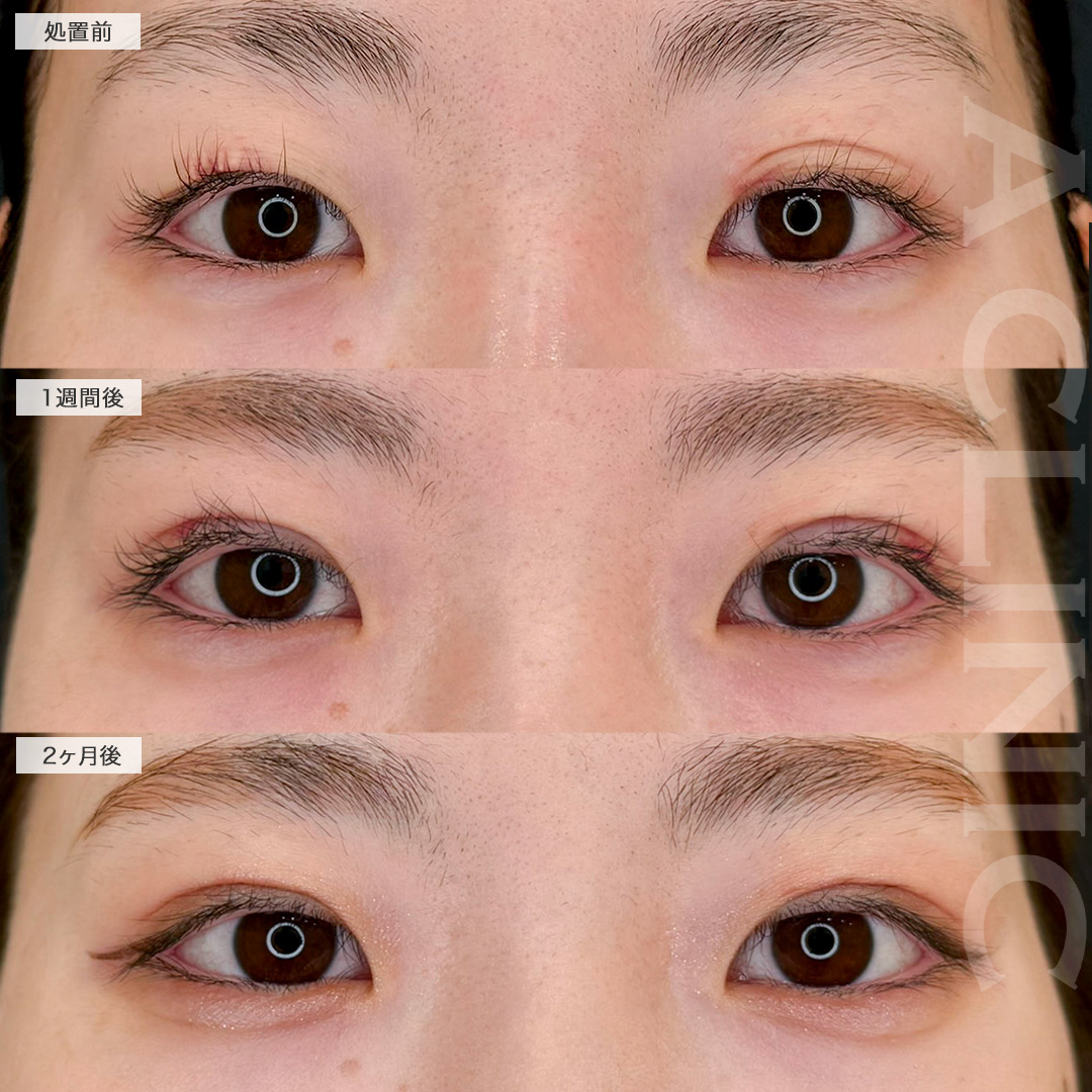 二重術埋没法で一番似合う場所でラインを作り可愛さアップ!こちら処置前と2ヶ月後の症例です(20代女性)