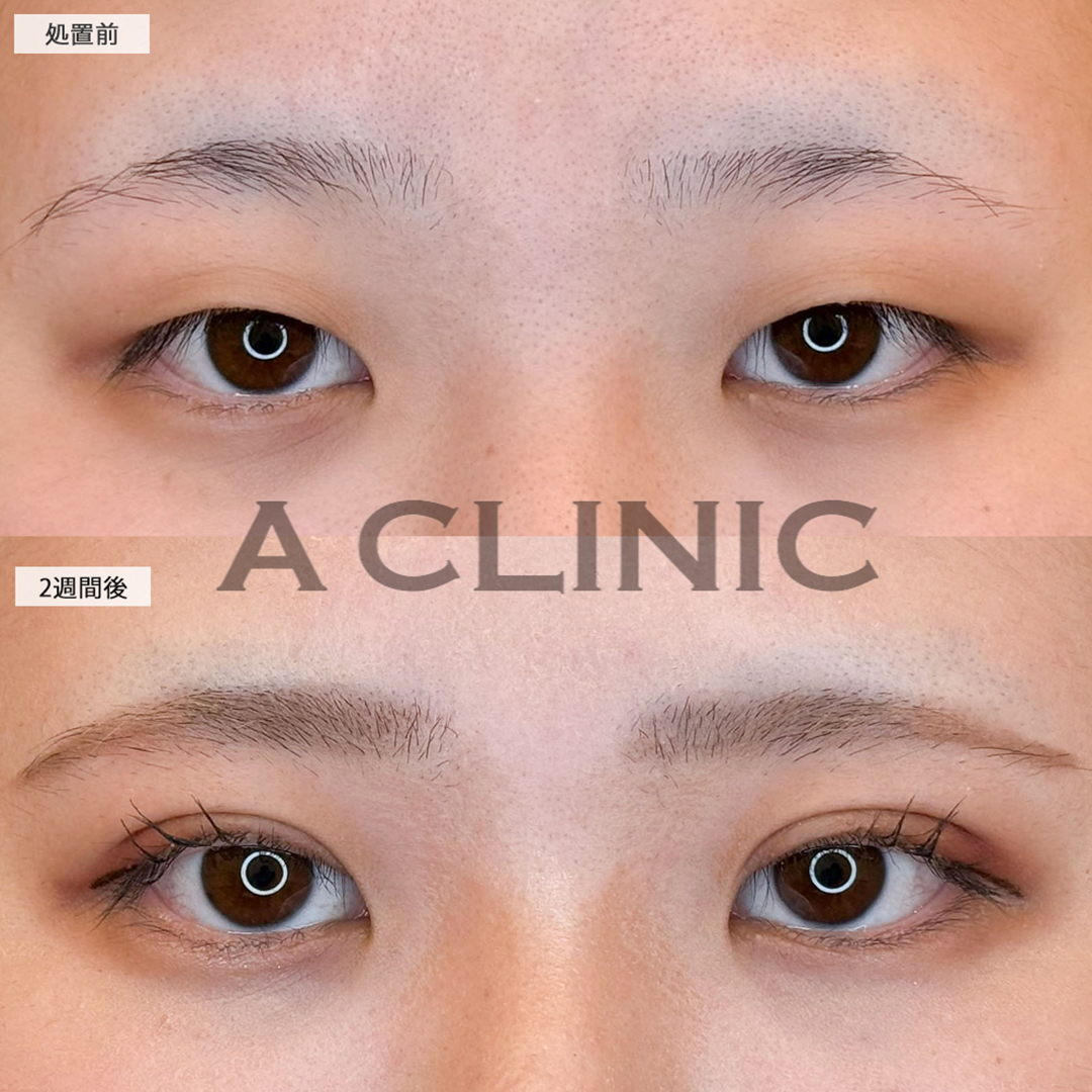 二重術埋没法で華やかな目元になり自信が持てるようになりました！こちら処置前と2週間後の症例です(20代女性)