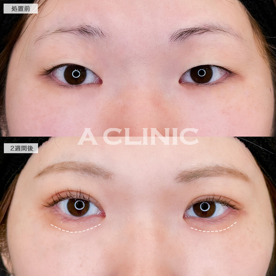 二重術埋没法と涙袋形成術でパッチリでちゅるとしたお目元へお目元へ!処置前と2週間後の症例です(30代女性)