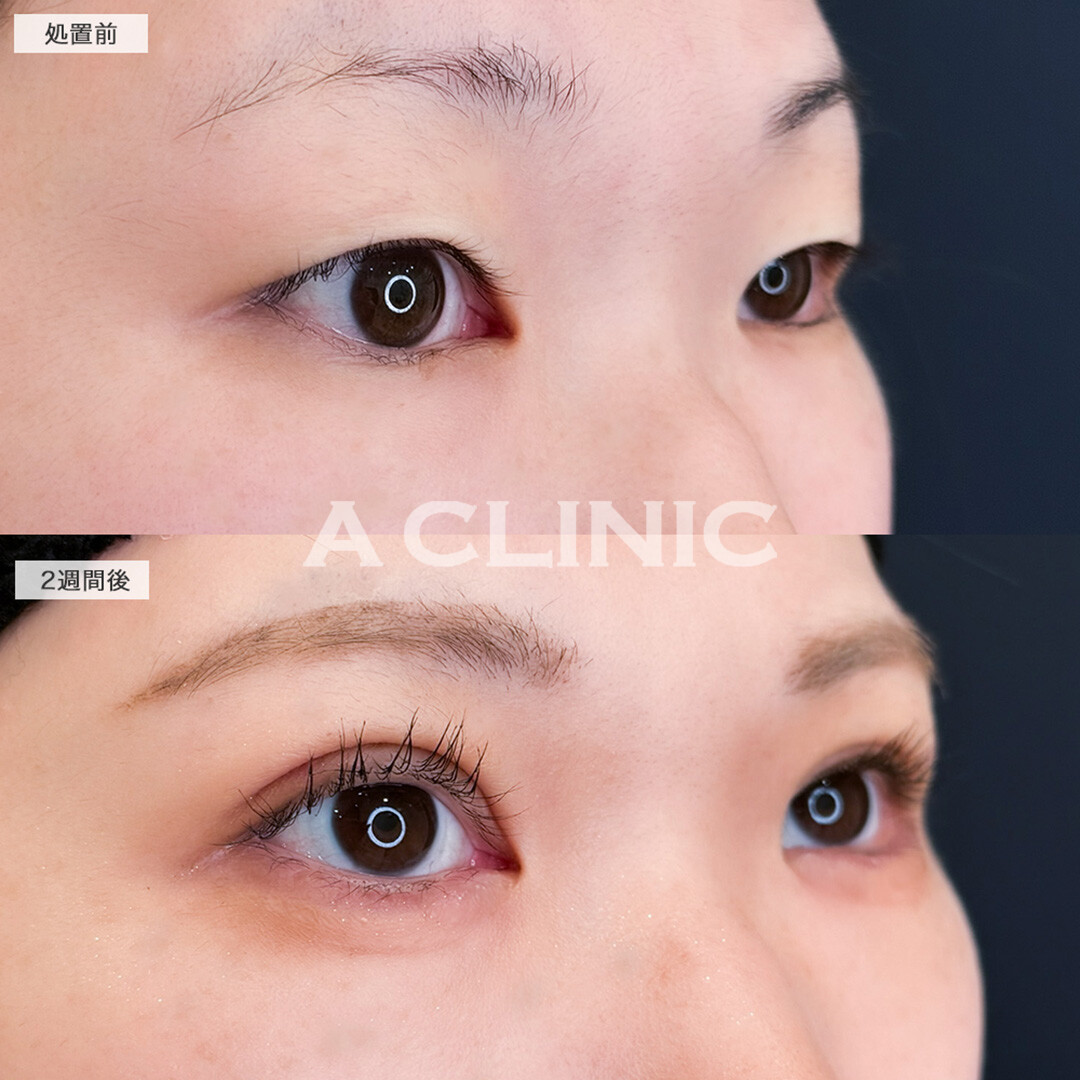 二重術埋没法と涙袋形成術でパッチリでちゅるとしたお目元へお目元へ!処置前と2週間後の症例です(30代女性)