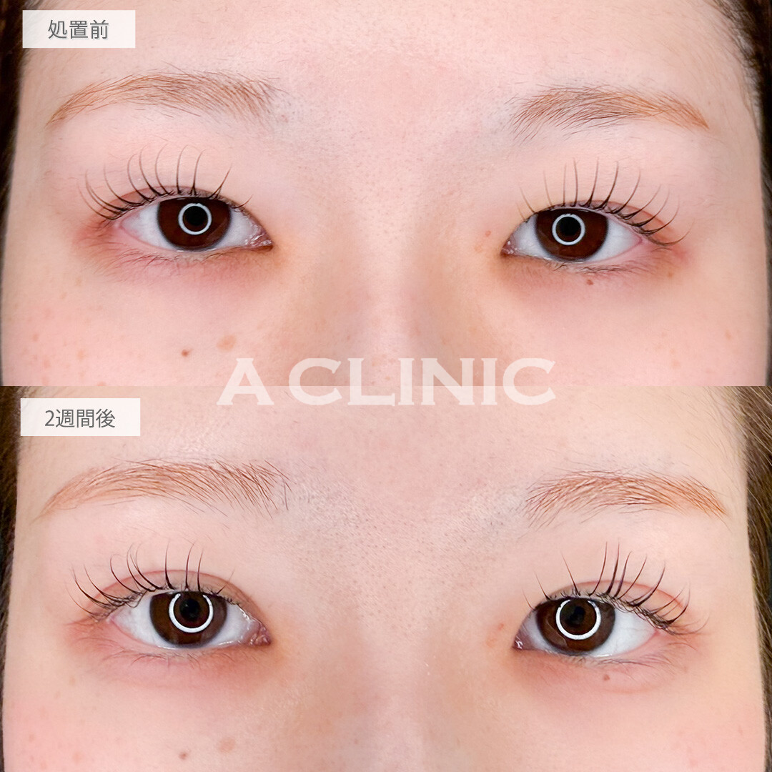 二重術埋没法で自然に目の見開きアップし印象の良い目元に！処置前と2週間後の症例です(20代女性)