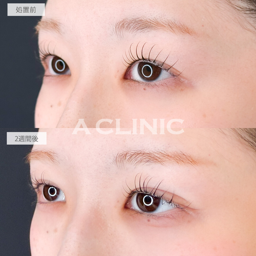 二重術埋没法で自然に目の見開きアップし印象の良い目元に！処置前と2週間後の症例です(20代女性)