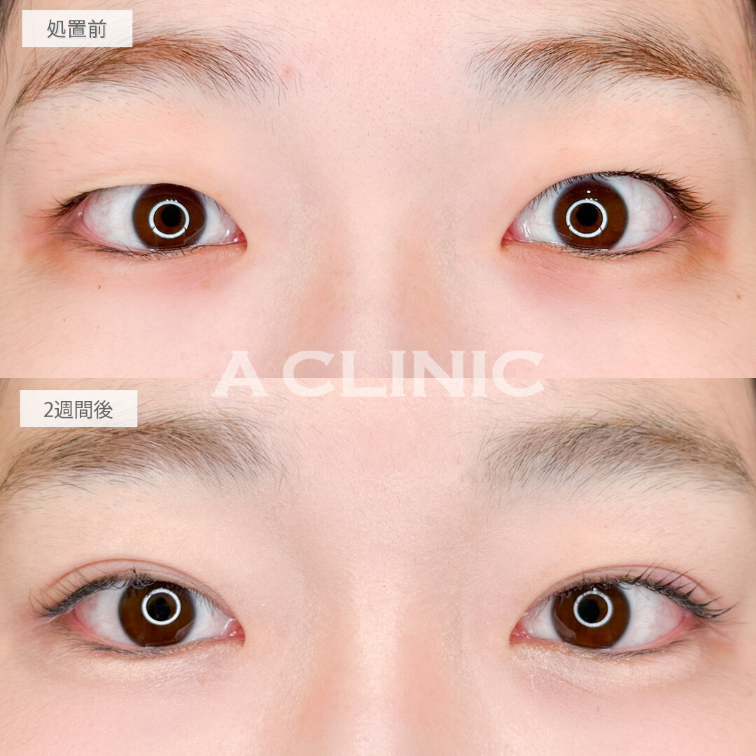 二重術埋没法でダウンタイムも少なく整形感のないナチュラルな末広二重になれました！処置前と直後の症例です(20代女性)