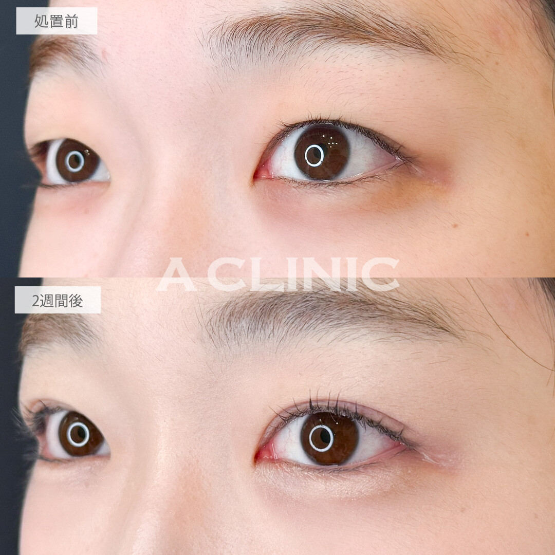 二重術埋没法でダウンタイムも少なく整形感のないナチュラルな末広二重になれました！処置前と直後の症例です(20代女性)