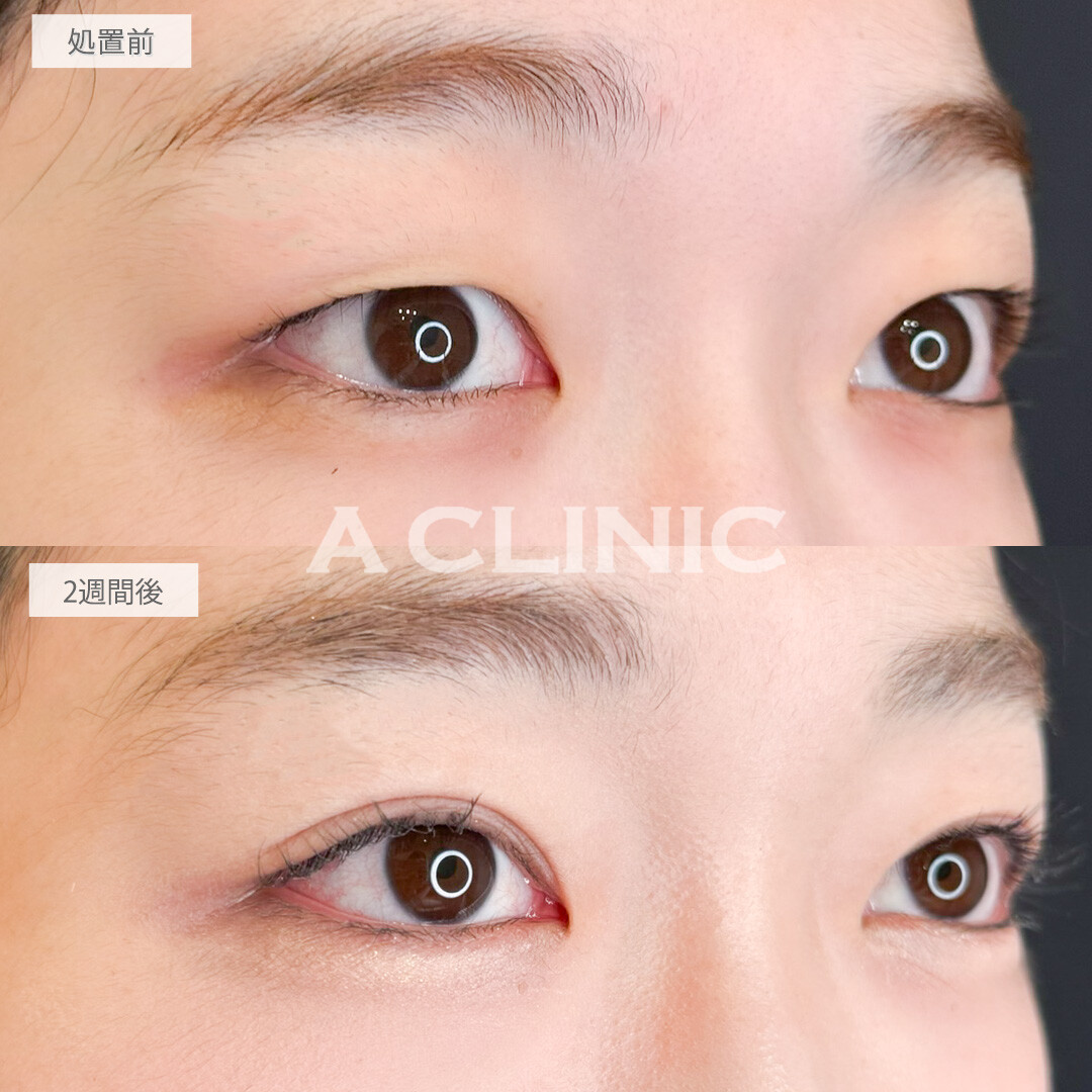 二重術埋没法でダウンタイムも少なく整形感のないナチュラルな末広二重になれました！処置前と直後の症例です(20代女性)