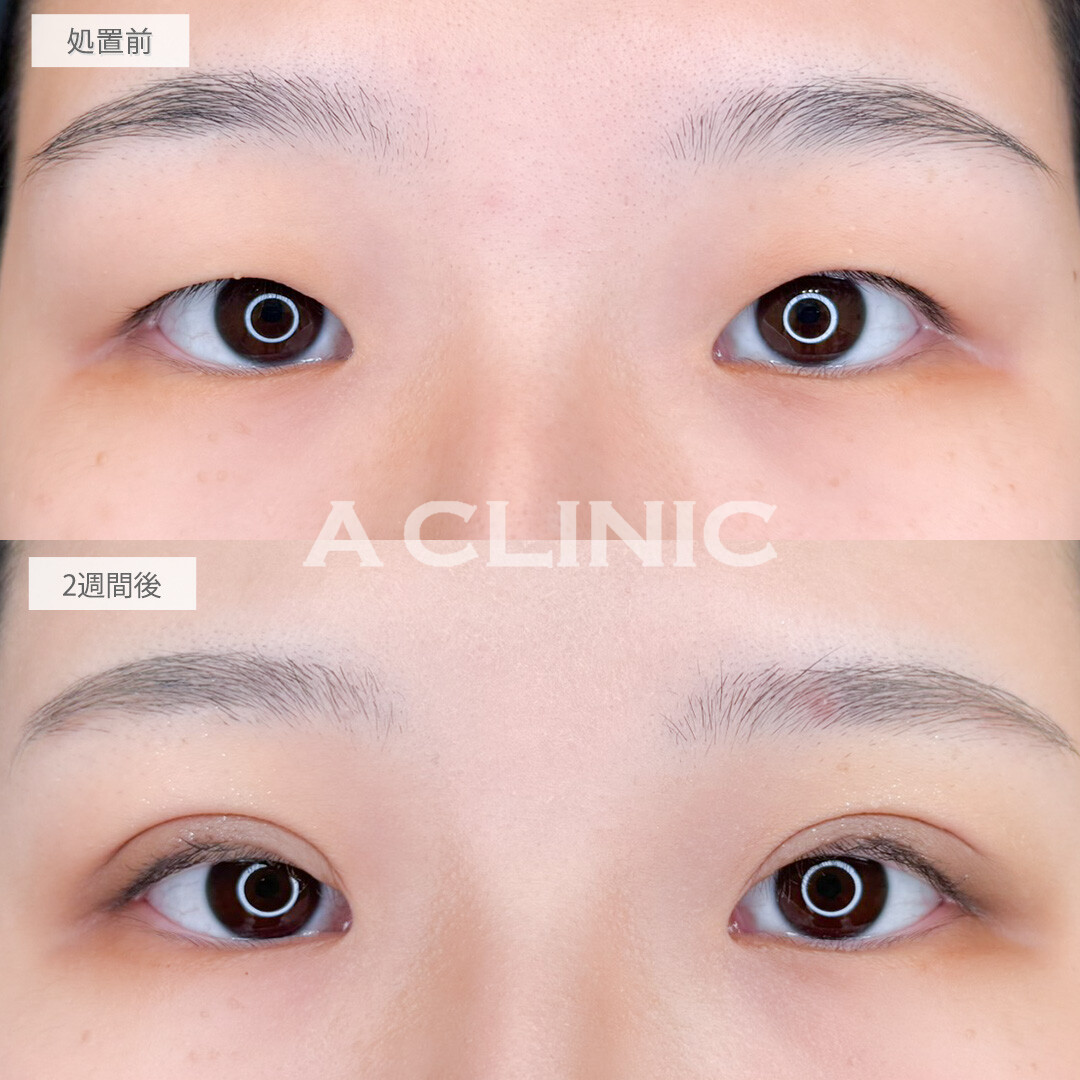 二重術埋没法と目の上の脂肪取りで重たい瞼でもくっきり二重に！処置前と2週間後の症例です(20代女性)