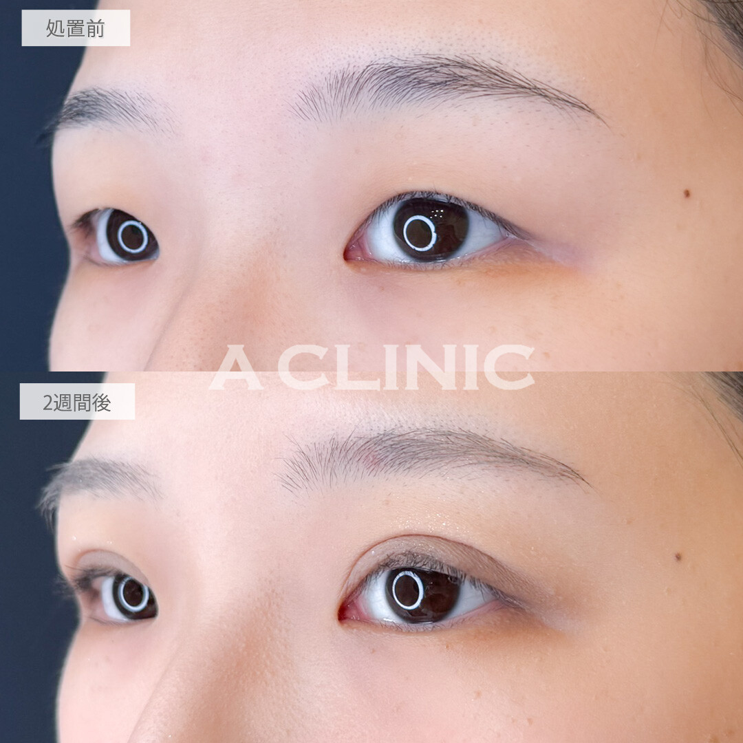 二重術埋没法と目の上の脂肪取りで重たい瞼でもくっきり二重に！処置前と2週間後の症例です(20代女性)