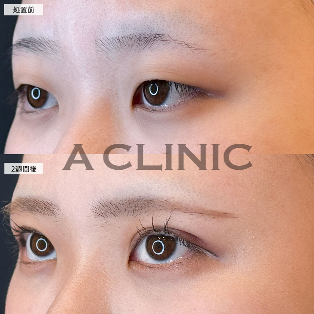 二重術埋没法で華やかな目元になり自信が持てるようになりました！こちら処置前と2週間後の症例です(20代女性)