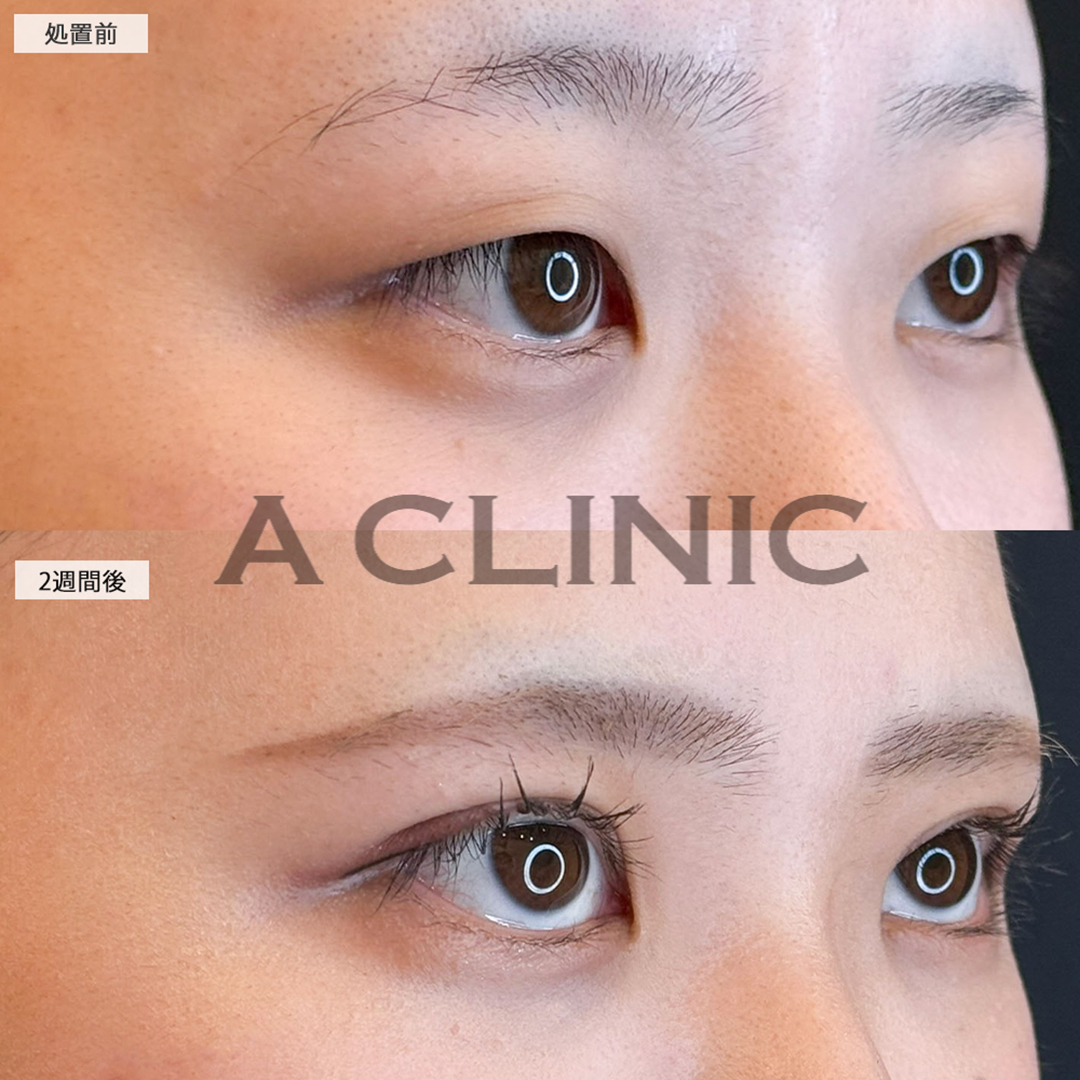 二重術埋没法で華やかな目元になり自信が持てるようになりました！こちら処置前と2週間後の症例です(20代女性)