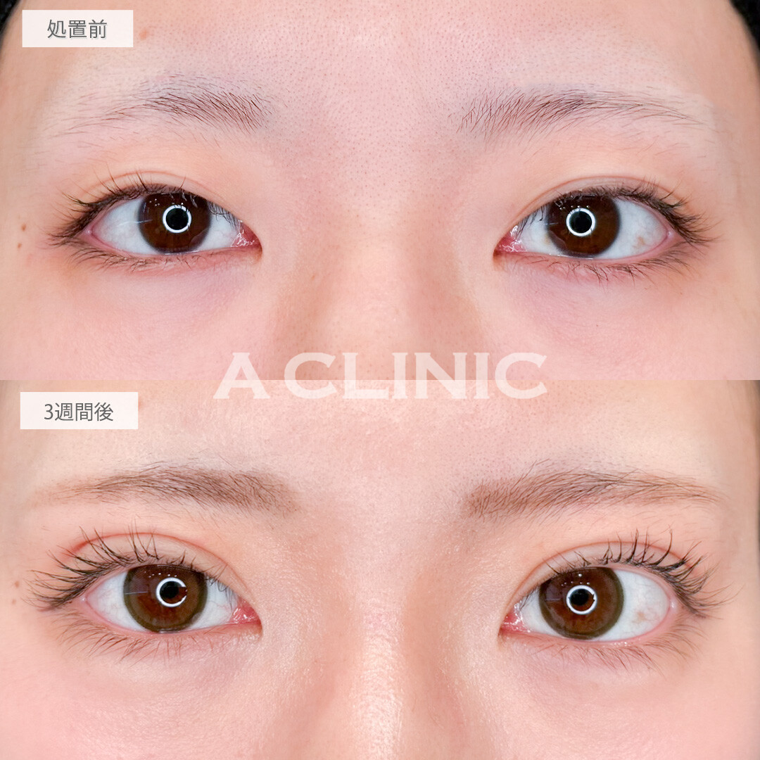 二重術埋没法で目の見開きもよくなりました！処置前と3週間後の症例です(20代女性)