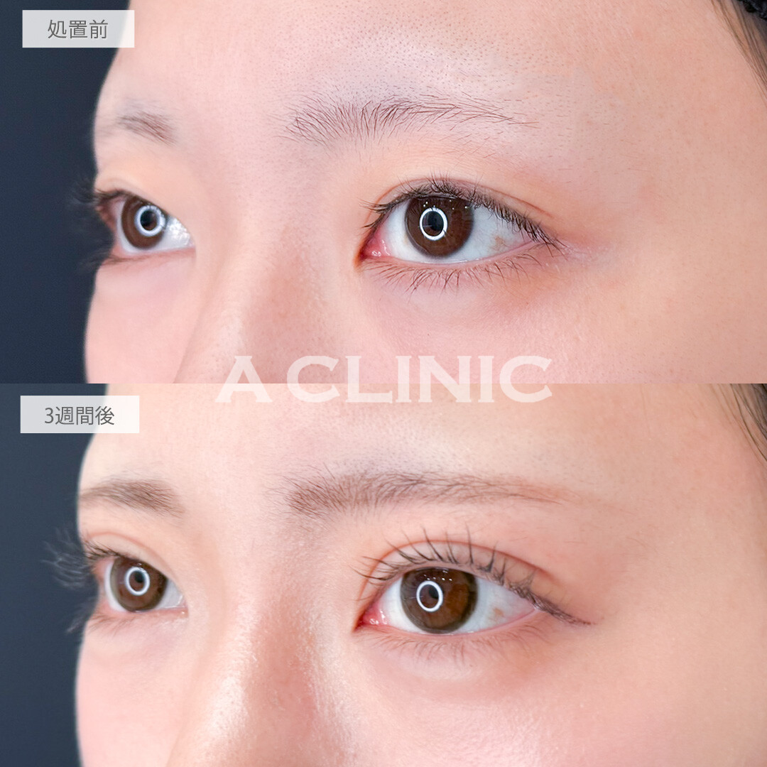 二重術埋没法で目の見開きもよくなりました！処置前と3週間後の症例です(20代女性)