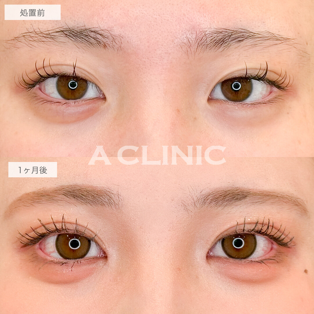 二重術埋没法と目頭切開で華やかなお目元に！処置前と1ヶ月後の症例です(10代女性)