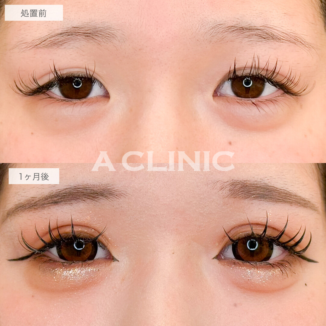 二重術埋没法ならメイク映えする幅広二重になれます！処置前と1ヶ月後の症例です(20代女性)