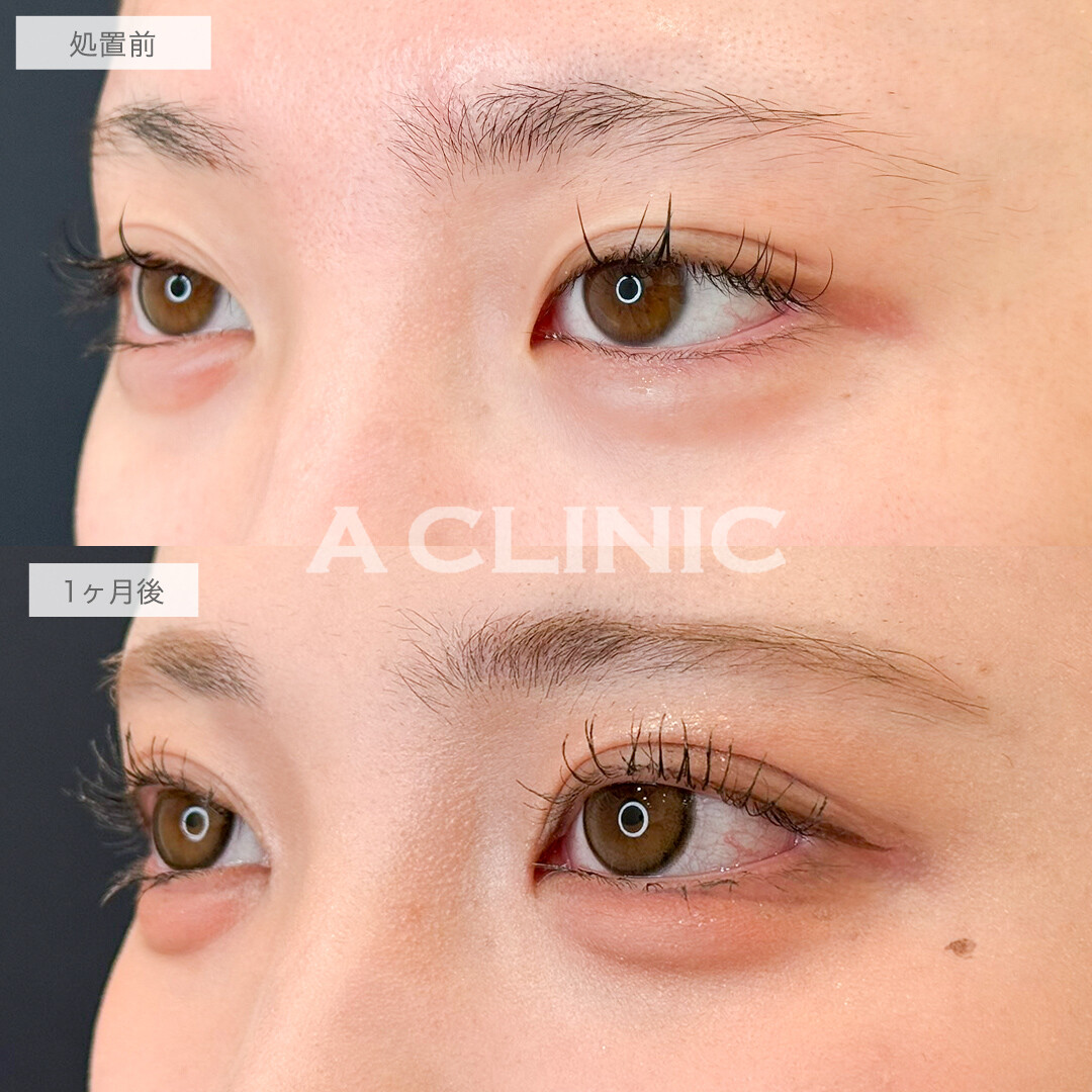 二重術埋没法と目頭切開で華やかなお目元に！処置前と1ヶ月後の症例です(10代女性)