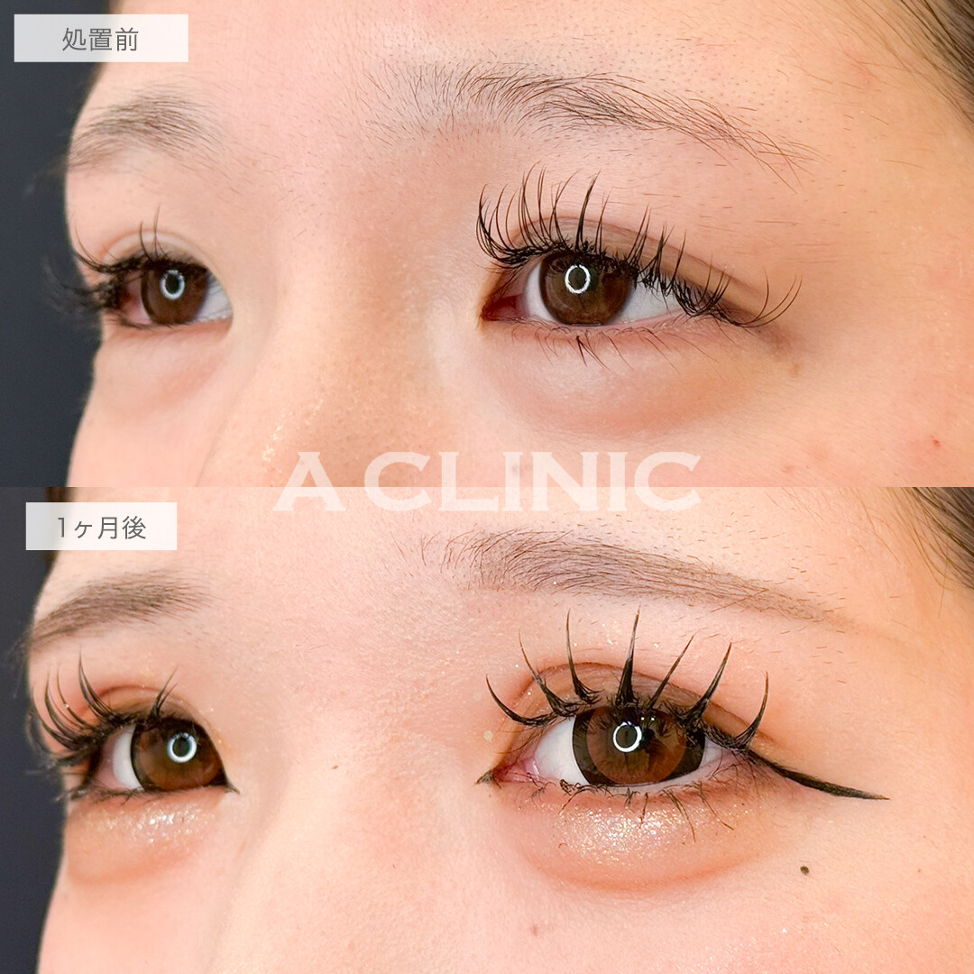 二重術埋没法ならメイク映えする幅広二重になれます！処置前と1ヶ月後の症例です(20代女性)
