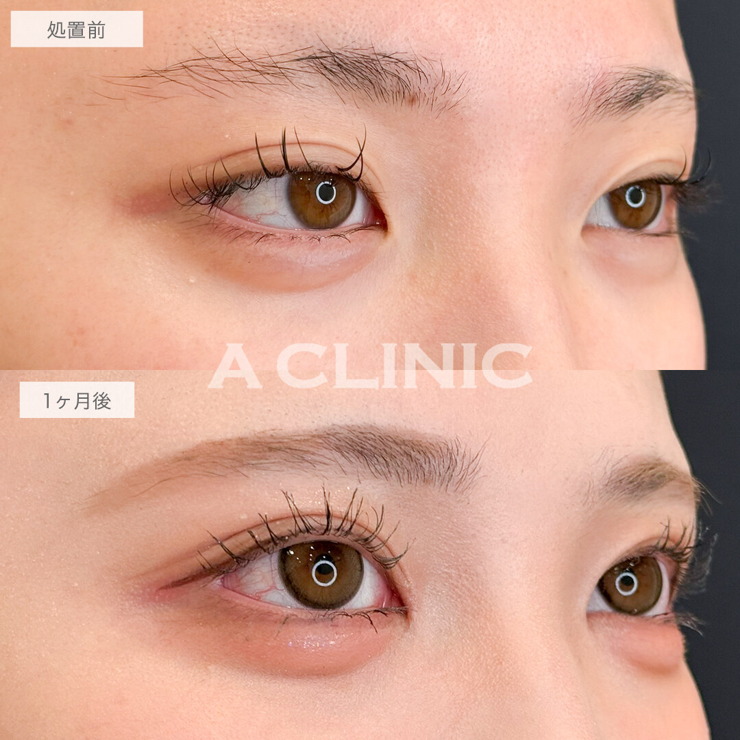 二重術埋没法と目頭切開で華やかなお目元に！処置前と1ヶ月後の症例です(10代女性)
