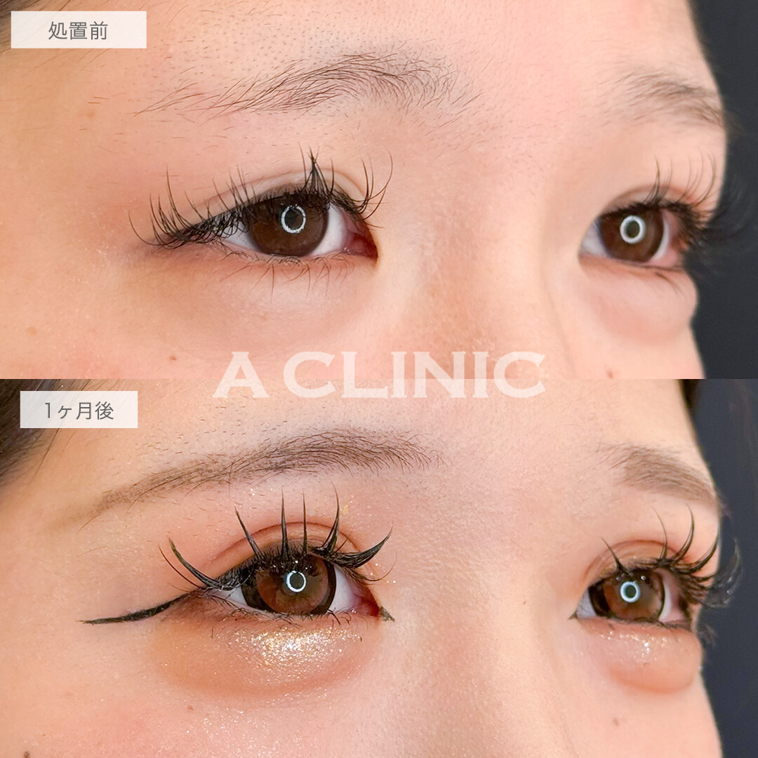二重術埋没法ならメイク映えする幅広二重になれます！処置前と1ヶ月後の症例です(20代女性)