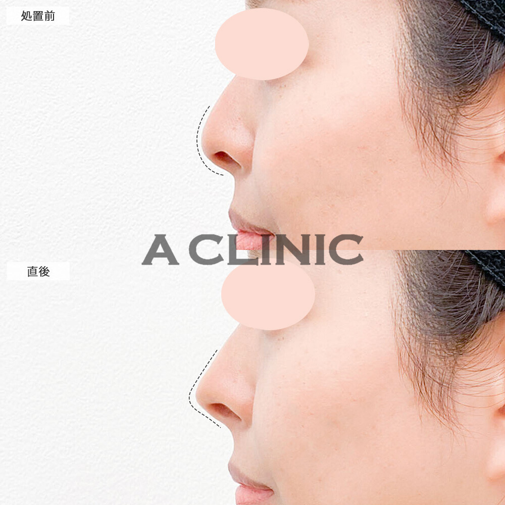 鼻ヒアルロン酸で注射のみでツンとした鼻先へ！こちら処置前と直後の症例です(20代女性)
