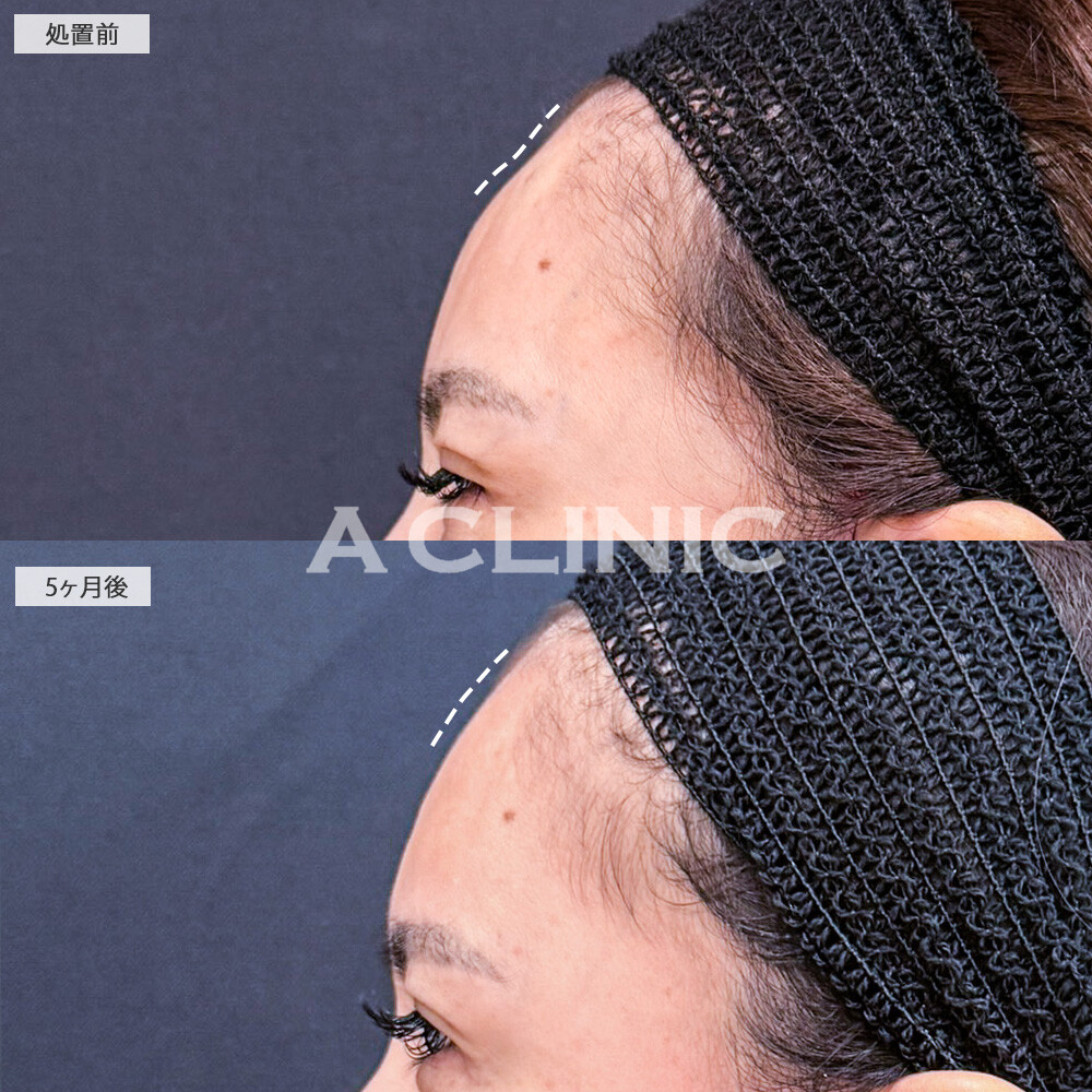 【直後の傷跡あり】A式美肌たるみ切開でたるみ改善した結果、5ヶ月経ってもたるまない輪郭を維持しています！こちら処置前と5ヶ月後の症例です(40代女性)