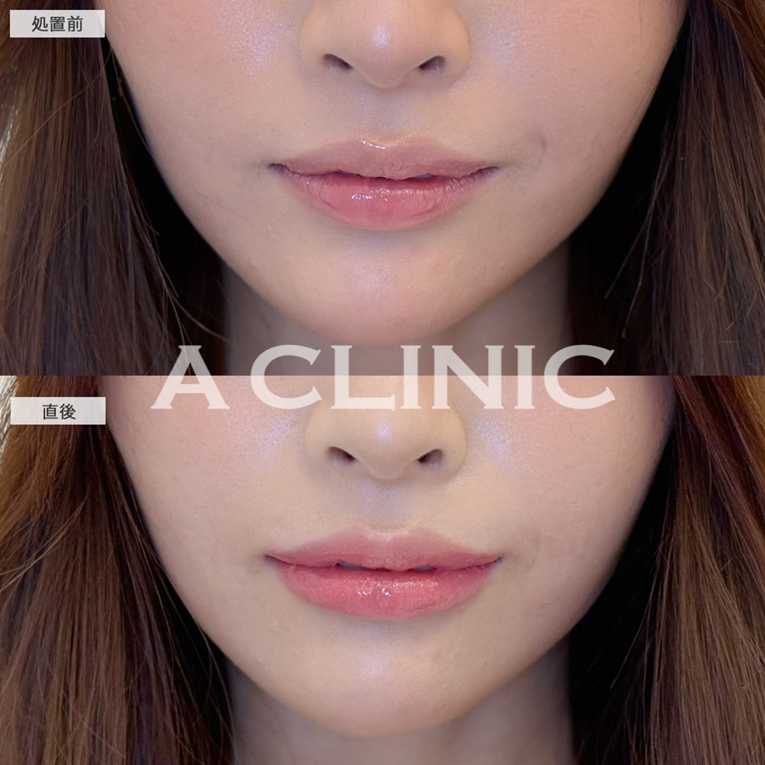 スマイルリップでうるぷる唇ゲット！こちら処置前と直後の症例です(20代女性)