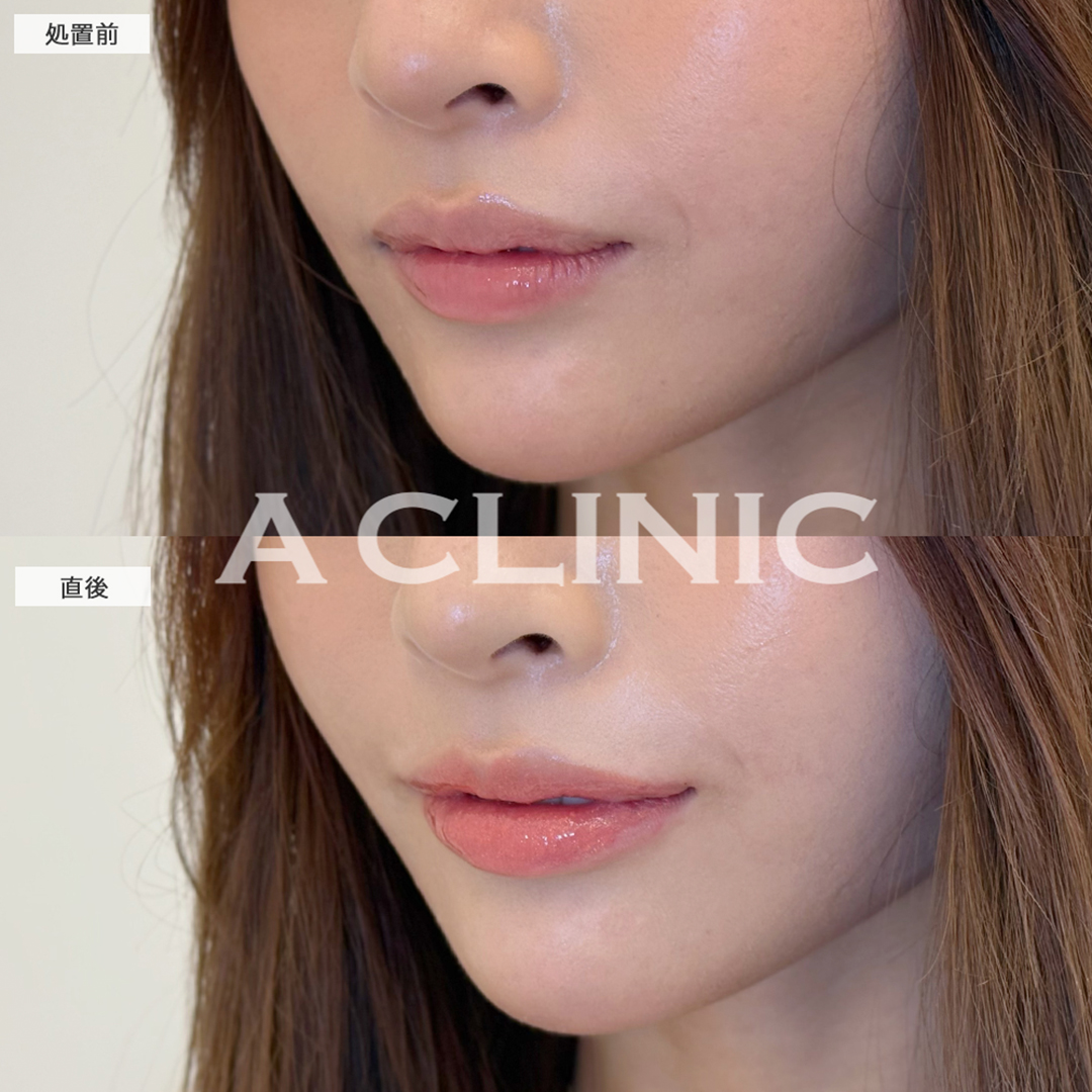 スマイルリップでうるぷる唇ゲット！こちら処置前と直後の症例です(20代女性)
