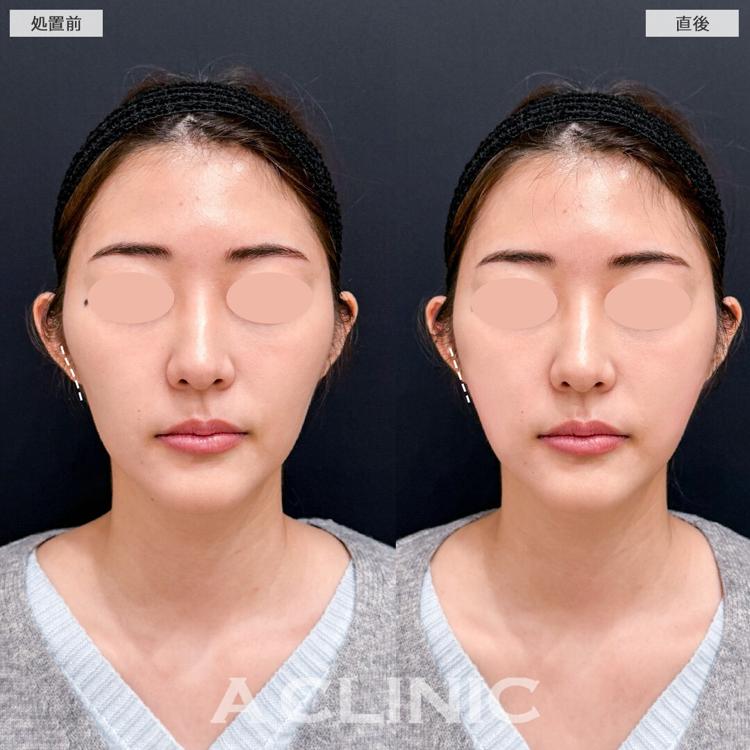 頬へのヒアルロン酸注入でひょうたん型の輪郭が卵型の輪郭に！こちら処置前と直後の症例です(20代女性)