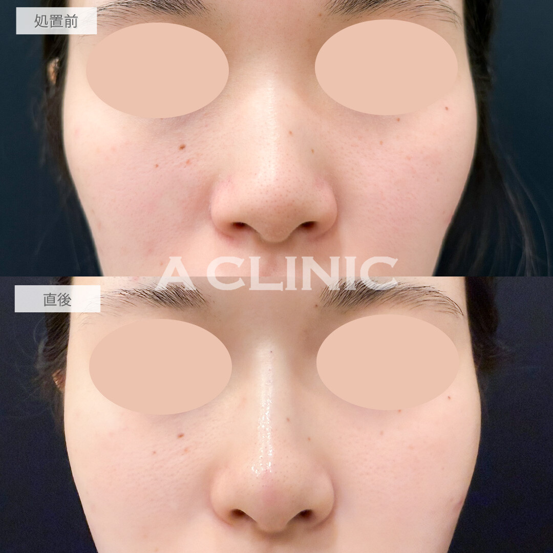 ジャスミンノーズでノーズシャドウなしでも鼻筋が通りました！処置前と直後の症例です(20代女性)