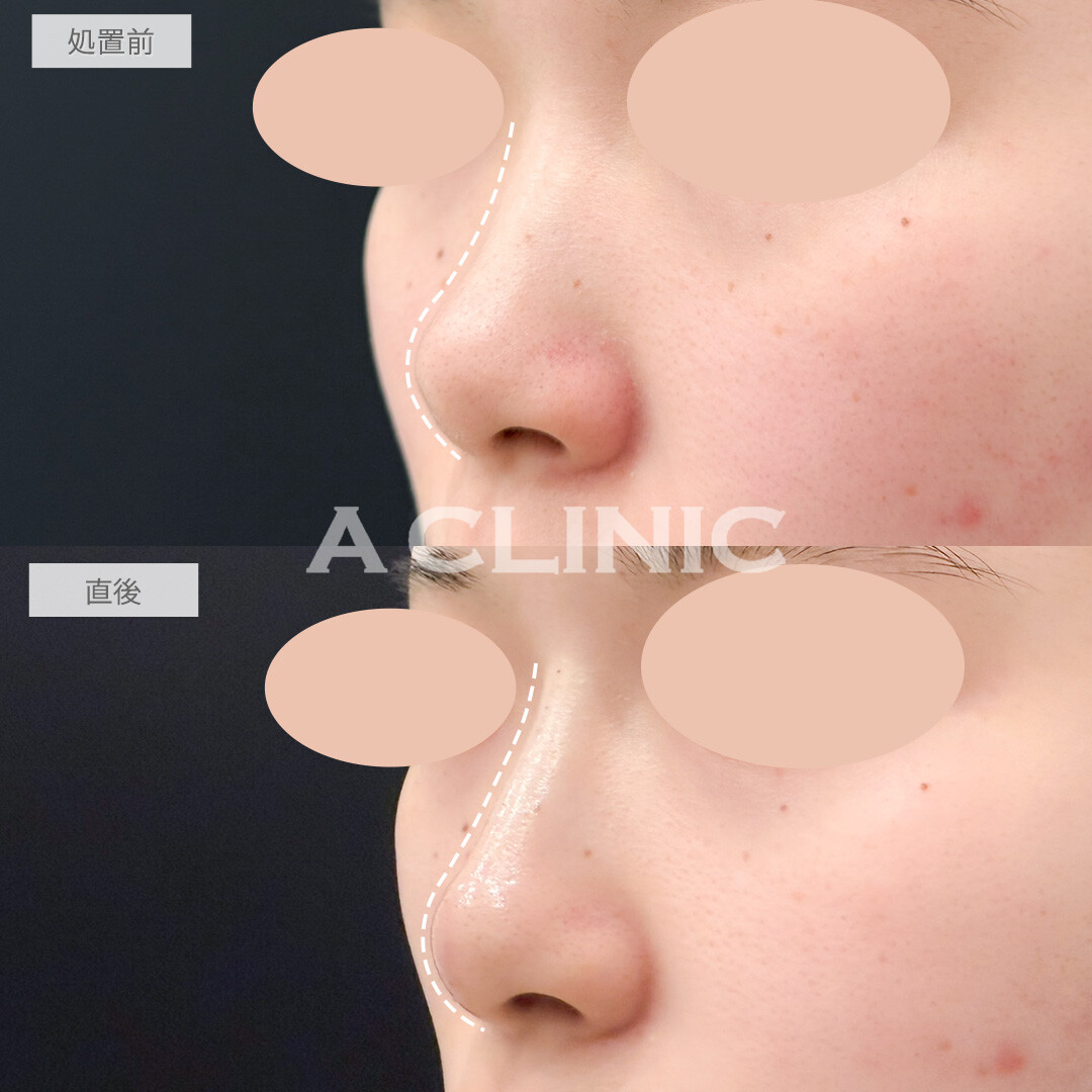 ジャスミンノーズでノーズシャドウなしでも鼻筋が通りました！処置前と直後の症例です(20代女性)