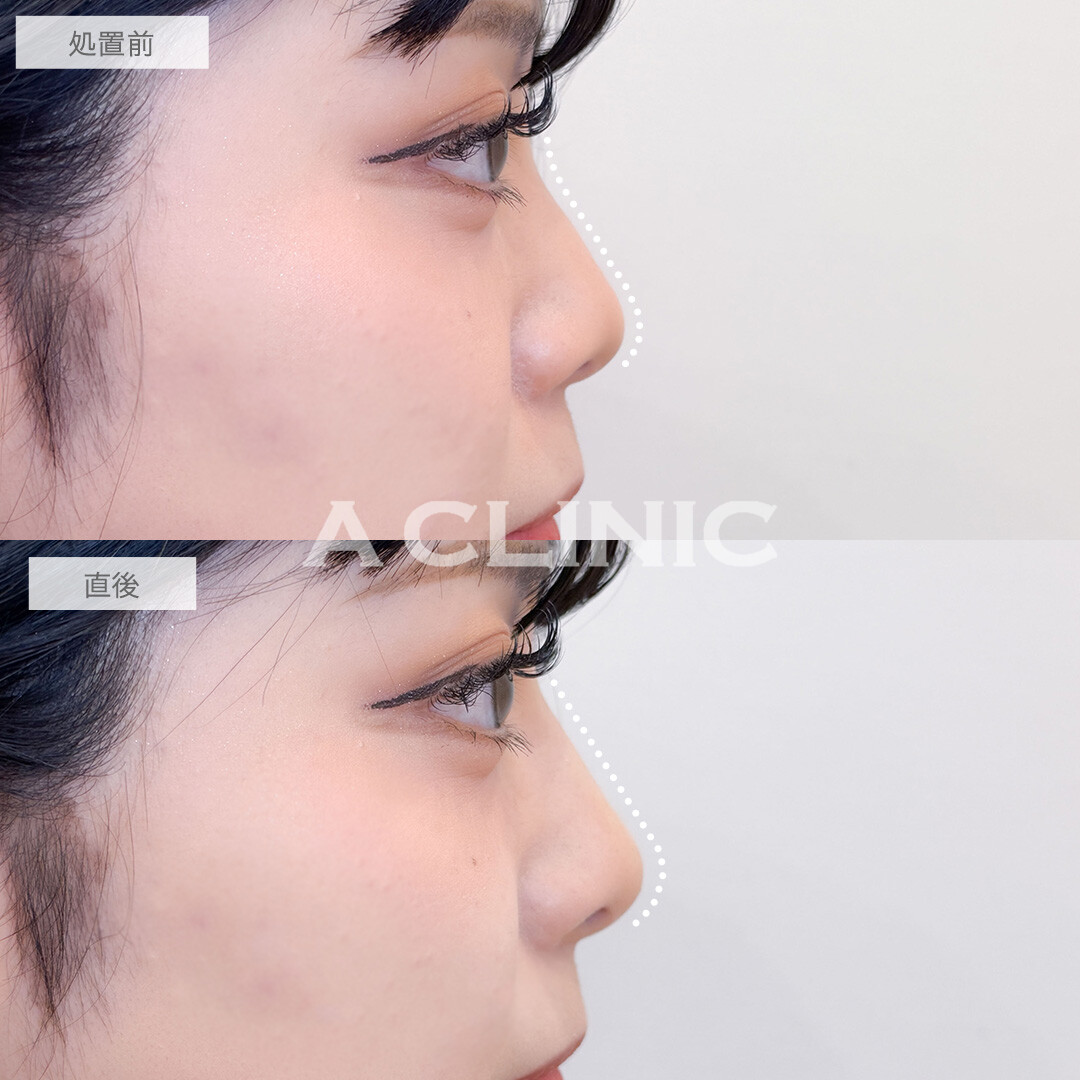 ジャスミンノーズで鼻筋を通して高さも出ました！こちら処置前と直後の症例です(20代女性)