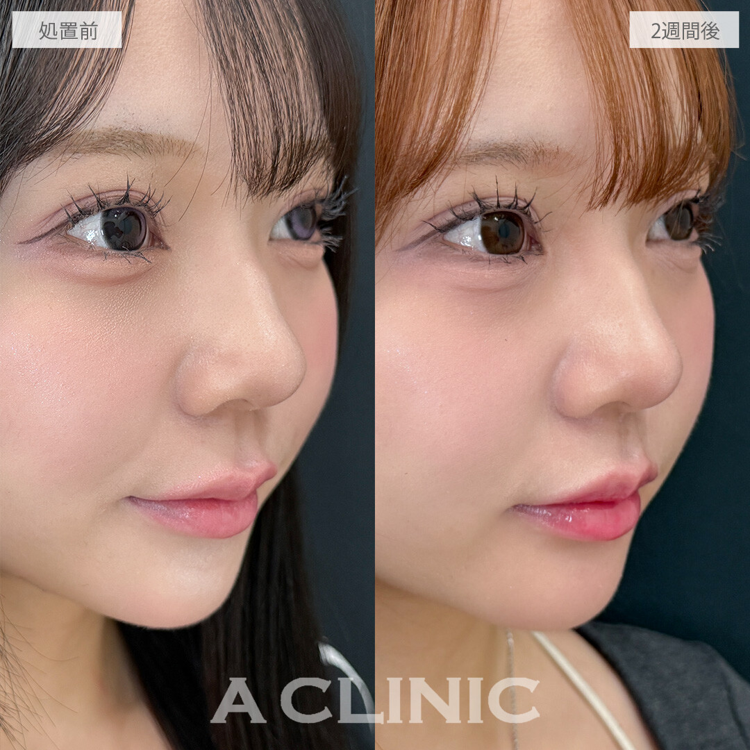 切らない人中短縮(Cカール形成術)ならお肌表面に傷跡を残さず人中を短くできます！こちら処置前と2週間後の症例です(20代女性)