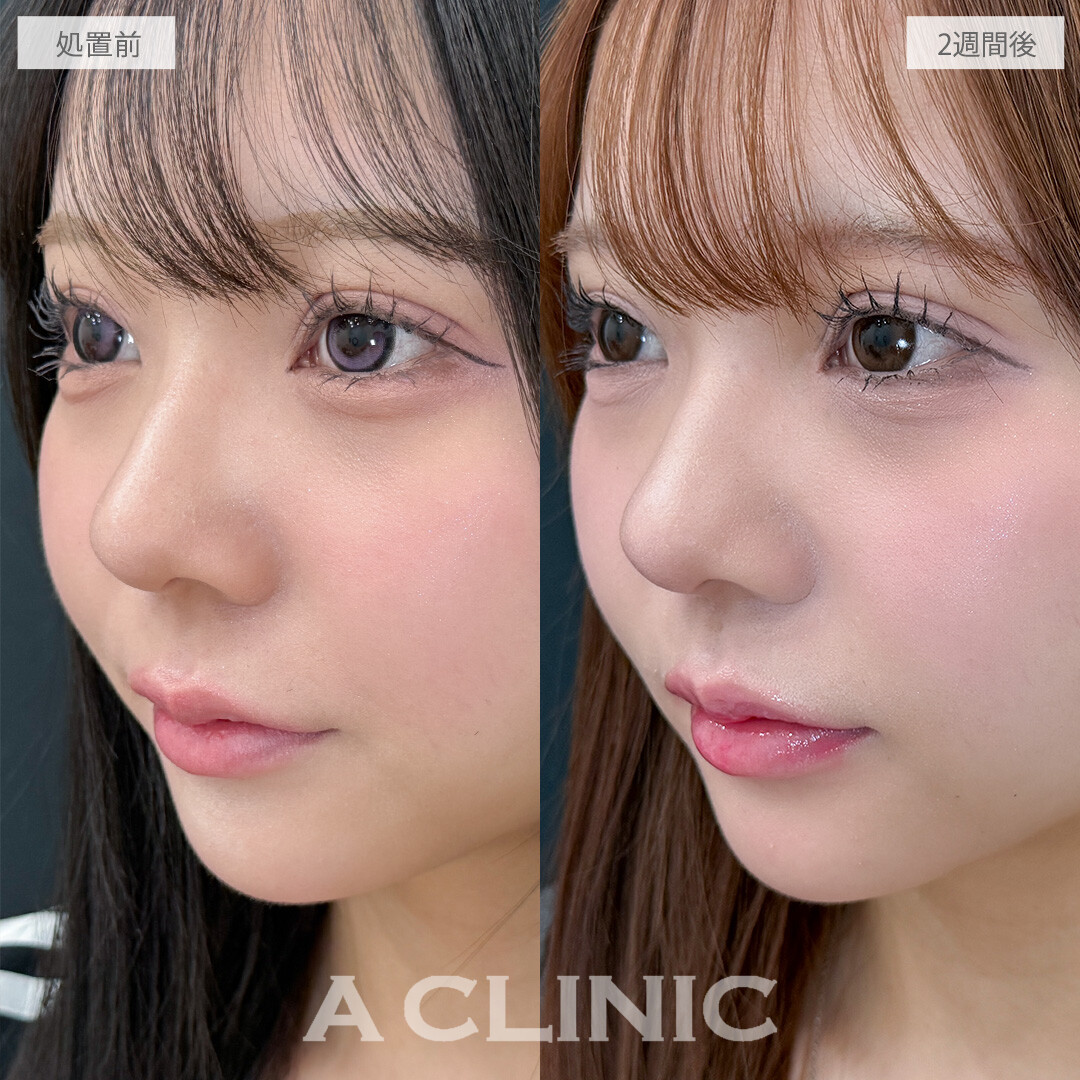 切らない人中短縮(Cカール形成術)ならお肌表面に傷跡を残さず人中を短くできます！こちら処置前と2週間後の症例です(20代女性)