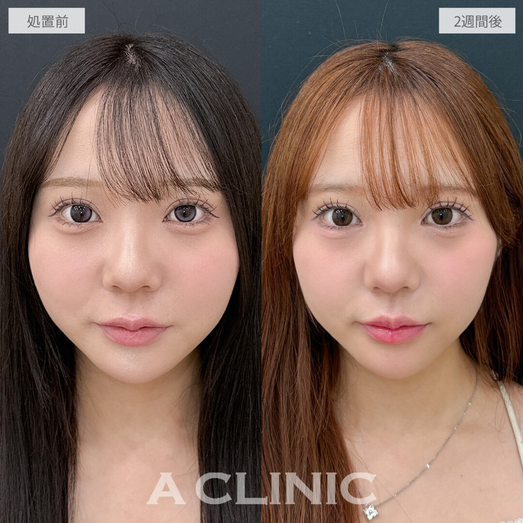 切らない人中短縮(Cカール形成術)ならお肌表面に傷跡を残さず人中を短くできます！こちら処置前と2週間後の症例です(20代女性)