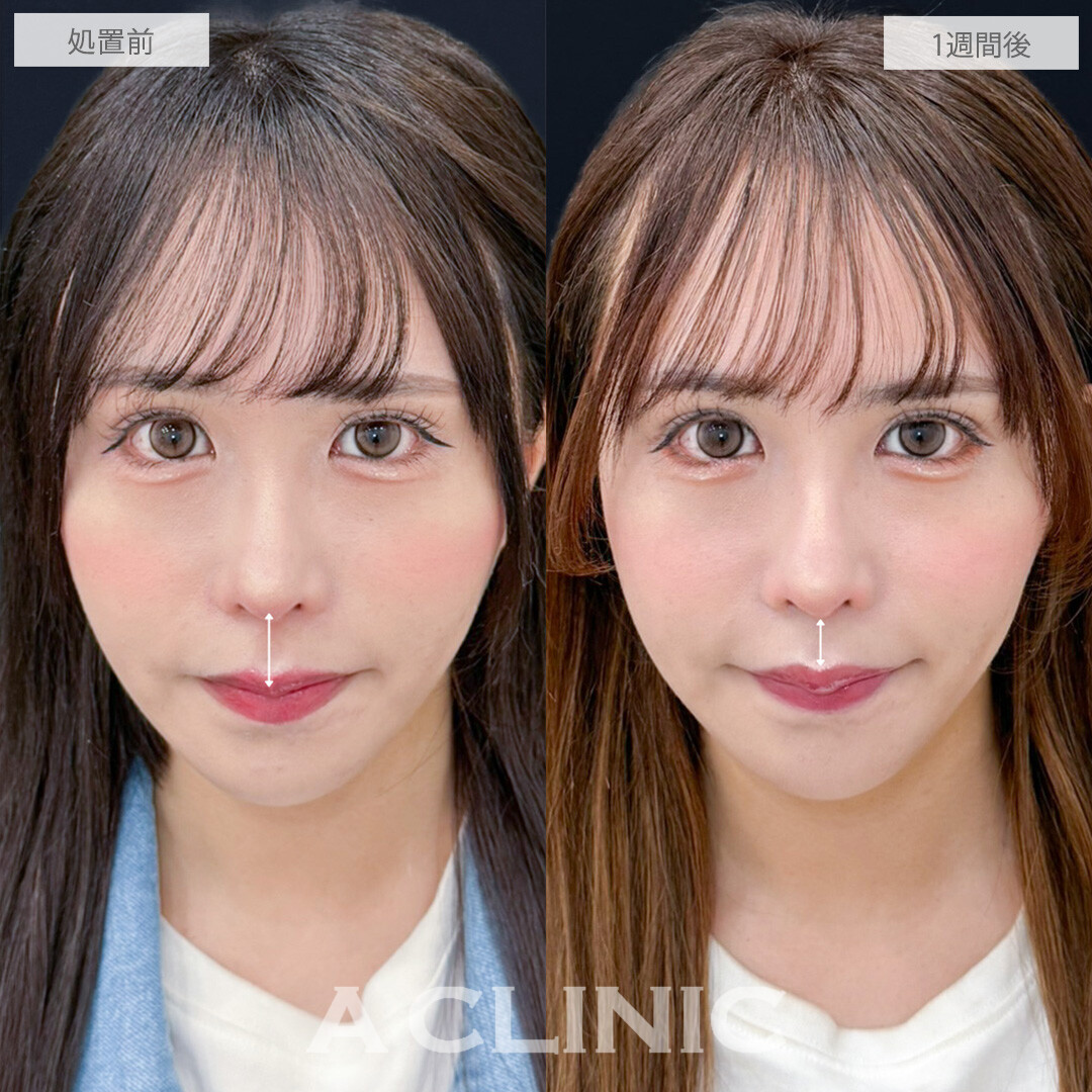 切らない人中短縮なら術後1週間でもこんなに自然！こちら処置前と1週間後の症例です(30代女性)