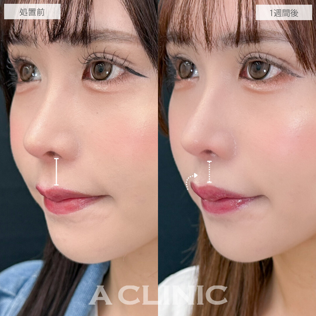 切らない人中短縮なら術後1週間でもこんなに自然！こちら処置前と1週間後の症例です(30代女性)