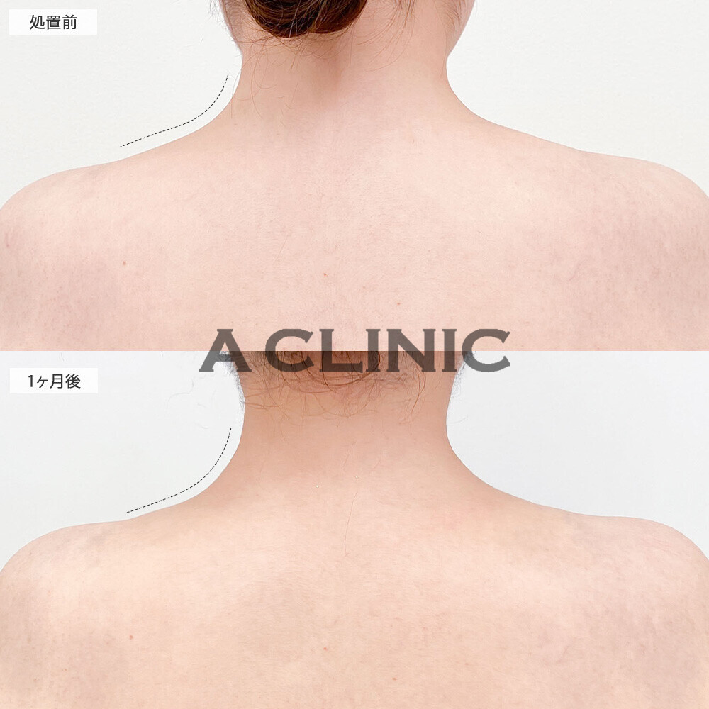 ボトックス注射(肩)で肩の張りが収まりました！こちら処置前と１ヶ月後の症例です(30代女性)