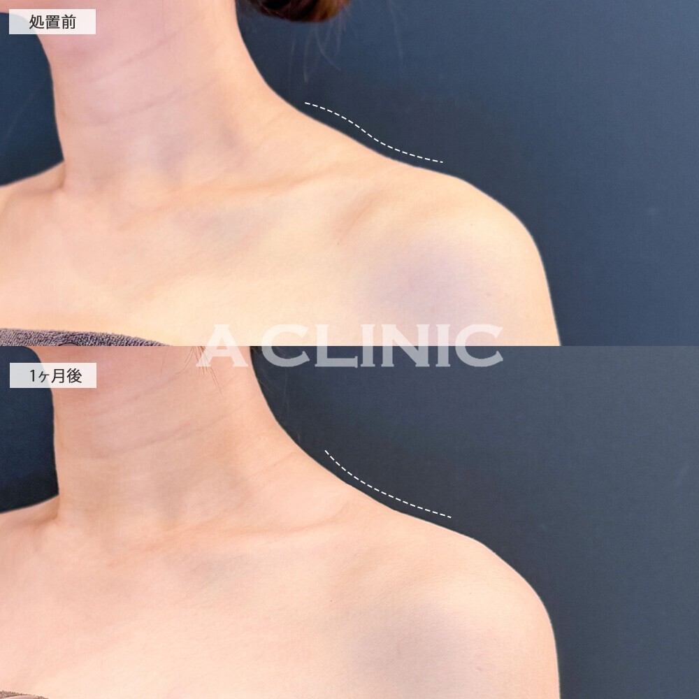 ボトックス注射(肩)で肩こりも改善し見た目もスッキリ！こちら処置前と１ヶ月後の症例です(20代女性)