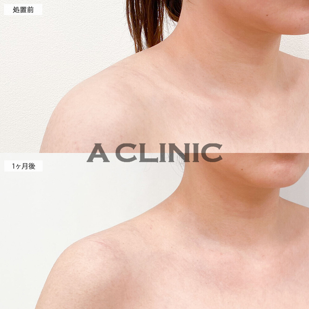 ボトックス注射(肩)で肩の張りが収まりました！こちら処置前と１ヶ月後の症例です(30代女性)